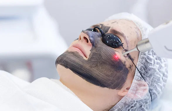 Carbon Laser Facial